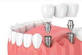 IV-TI-202302-SEDE CENTRAL - CHIMBOTE-ODONTOLOGÍA SEGUNDA ESPECIALIDAD EN PERIODONCIA E IMPLANTES-000993